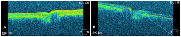 【佳学基因检测】巨额花费肾移植，却得了视网膜纤毛病：基因检测在肾病与眼科共病中的作用
